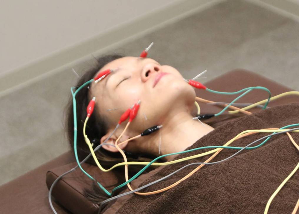 美容鍼によるフェイスケアの様子