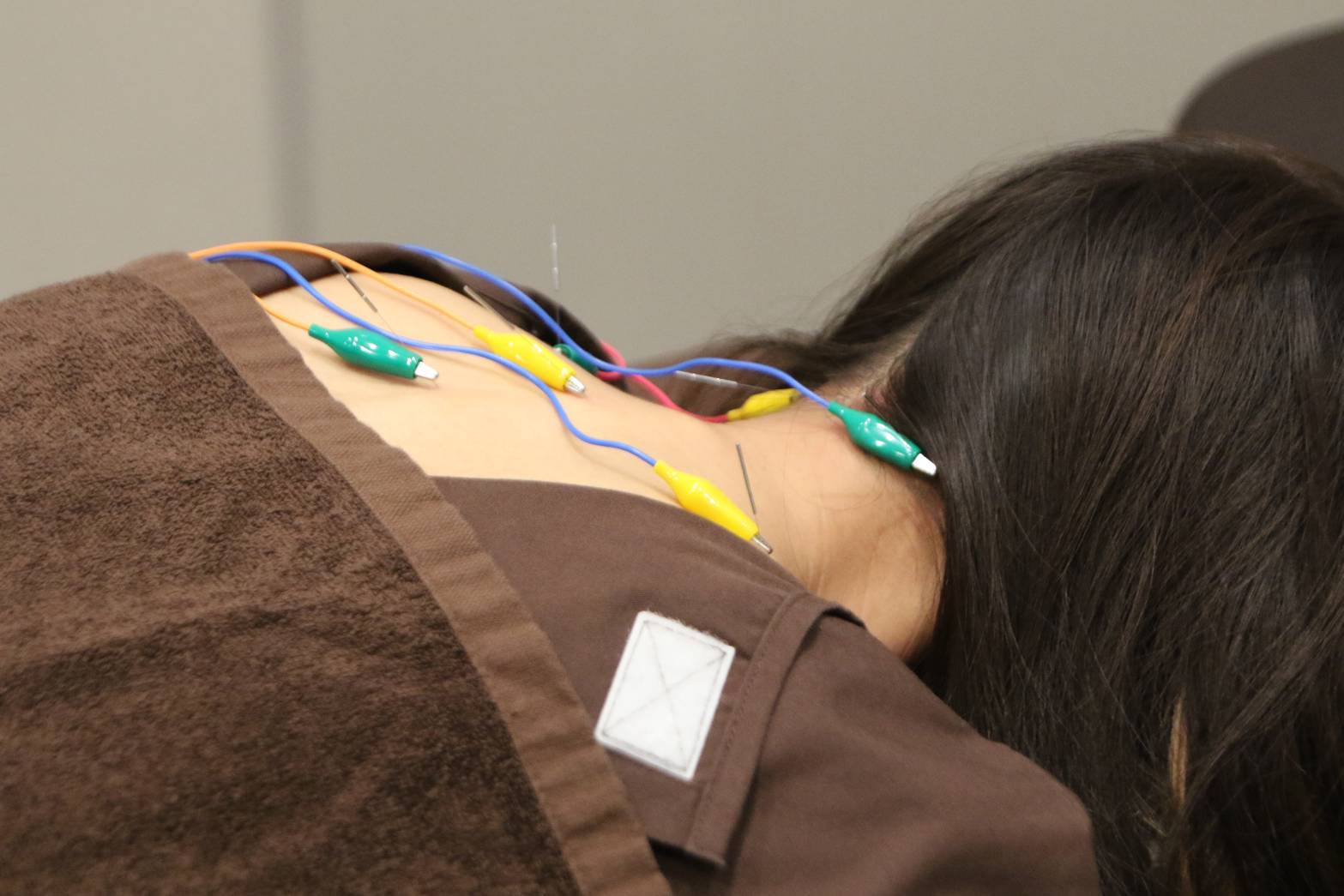 鍼を使った施術の様子